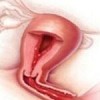 Ovarian Fibroids