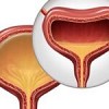 Myomectomy Fibroids